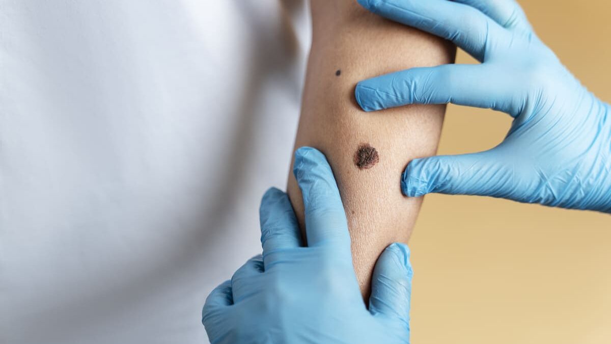Sabe reconhecer um melanoma?
