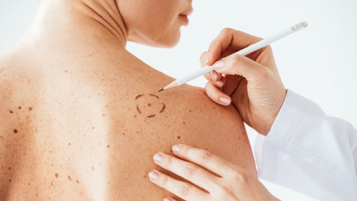 Dia Europeu do Melanoma: uma campanha para salvar vidas 