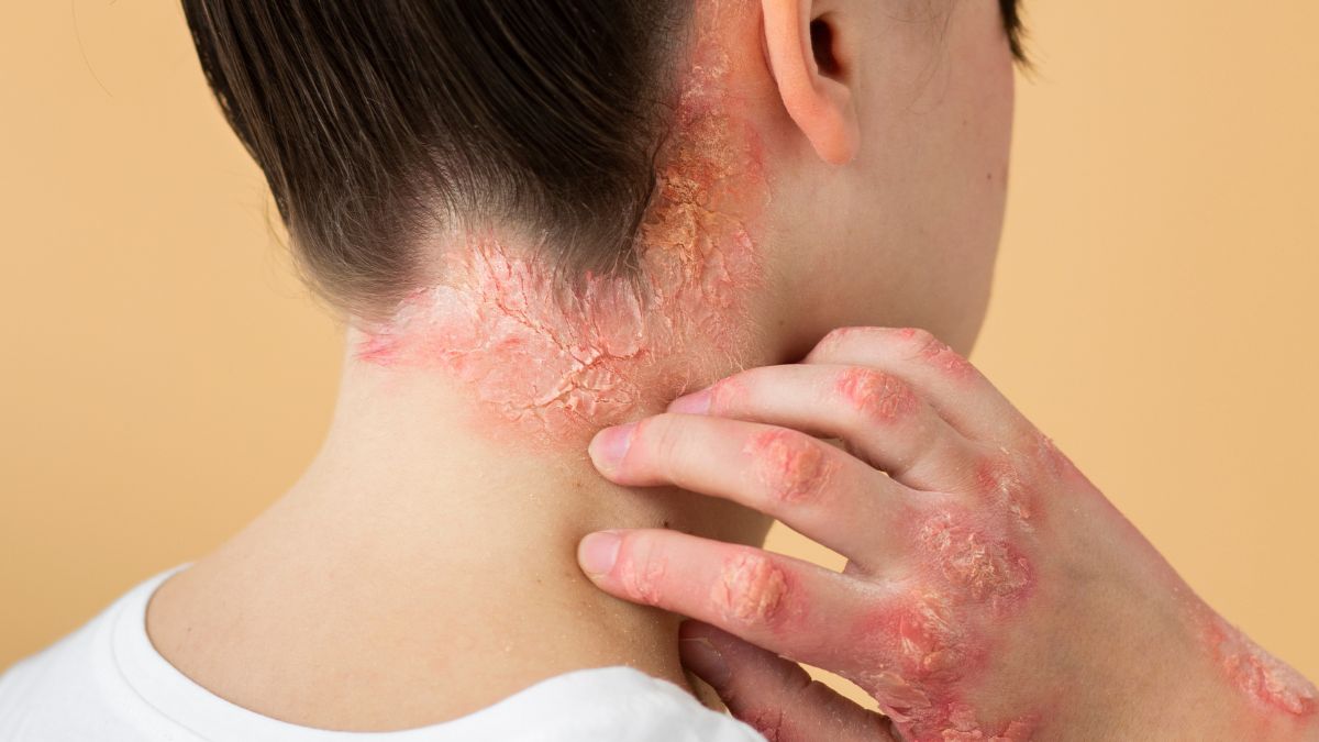 Psoríase: Sabe o que é? 