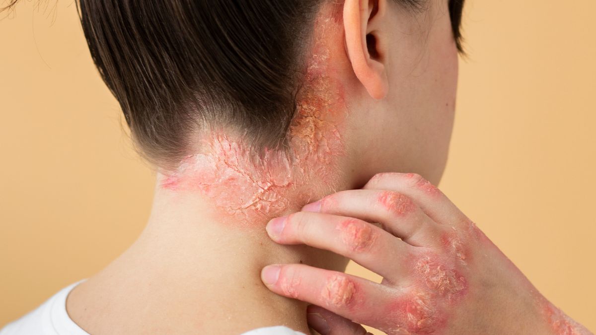 Dia mundial da psoríase desmistificar a doença e reduzir o estigma social